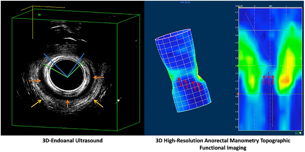 Neurogastro & Motil (@ngmjournal) on Twitter photo 🆕🔥3D-HR-ARM demonstrated high accuracy in detecting severe #ObstetricAnalSphincter #injuries ⏩Excluding their presence in young women with #AnalIncontinence symptoms‼️
🎯Combining 3D-HR-ARM with 3D-EAUS may enhance detection👏
👉onlinelibrary.wiley.com/doi/10.1111/nm…
<a href="/ANMSociety/">ANMS</a> <a href="/esnm_eu/">ESNM.eu</a> 🆕🔥3D-HR-ARM demonstrated high accuracy in detecting severe #ObstetricAnalSphincter #injuries ⏩Excluding their presence in young women with #AnalIncontinence symptoms‼️
🎯Combining 3D-HR-ARM with 3D-EAUS may enhance detection👏
👉onlinelibrary.wiley.com/doi/10.1111/nm…
<a href="/ANMSociety/">ANMS</a> <a href="/esnm_eu/">ESNM.eu</a>