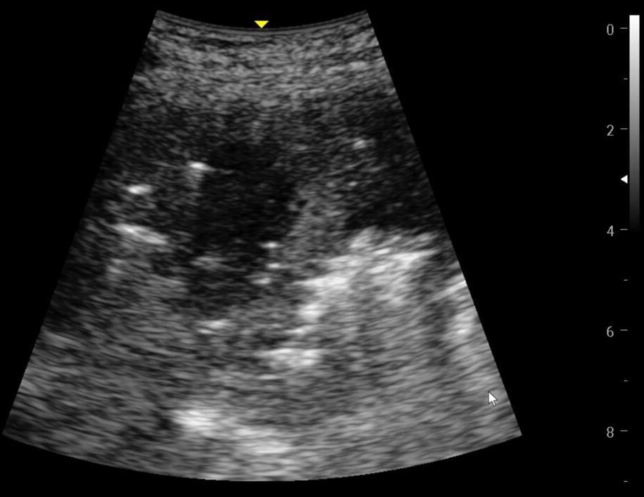 🧵 #AprendeConLUS | Mujer 37 a con epilepsia refractaria sufre múltiples crisis y llega a urgencias con ↓ conciencia, hipotensión e IRA tipo 1.

Lo que reveló el ultrasonido... salvó su vida.
Y no estaba en la Rx. 🫁🧠💥

¿Detectarías un absceso pulmonar solo con LUS?
👇