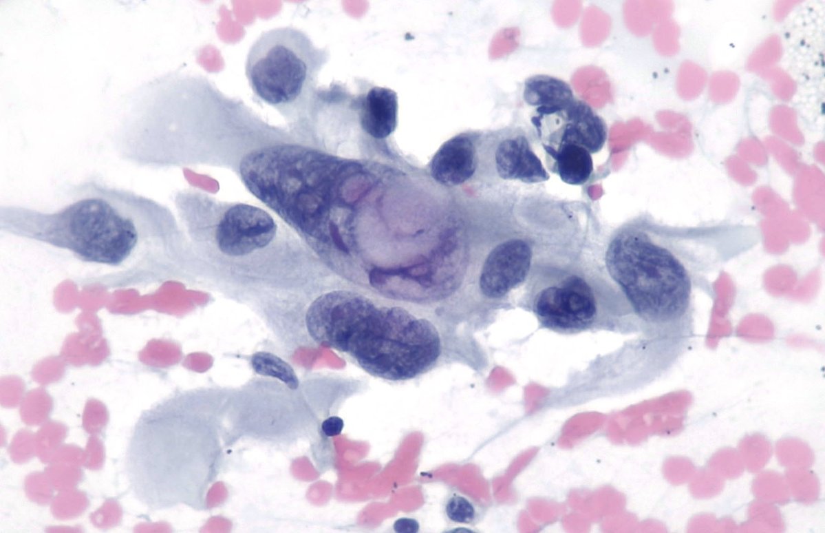 Lola Lozano (@mdlozanoe) on Twitter photo A huge nucleus, with huge INCIs (and other small ones). Among the list of tumors with INCIs 📝, don't forget lung adenocarcinoma 🤦♀️🕳️🔬💡
<a href="/EfcsYoung/">Young EFCS</a> <a href="/IACytology/">International Academy Cytology</a> <a href="/SECitologia/">Sociedad Española de Citología</a> <a href="/SEAP_IAP/">SEAP-IAP</a> <a href="/cytopathology/">Cytopathology.org</a> <a href="/CytopathologyJ/">Cytopathology</a> <a href="/CytologyEFCS/">EFCS</a> <a href="/slac2020/">SLAC - XXX Congreso 2021, Cartagena</a> A huge nucleus, with huge INCIs (and other small ones). Among the list of tumors with INCIs 📝, don't forget lung adenocarcinoma 🤦♀️🕳️🔬💡
<a href="/EfcsYoung/">Young EFCS</a> <a href="/IACytology/">International Academy Cytology</a> <a href="/SECitologia/">Sociedad Española de Citología</a> <a href="/SEAP_IAP/">SEAP-IAP</a> <a href="/cytopathology/">Cytopathology.org</a> <a href="/CytopathologyJ/">Cytopathology</a> <a href="/CytologyEFCS/">EFCS</a> <a href="/slac2020/">SLAC - XXX Congreso 2021, Cartagena</a>