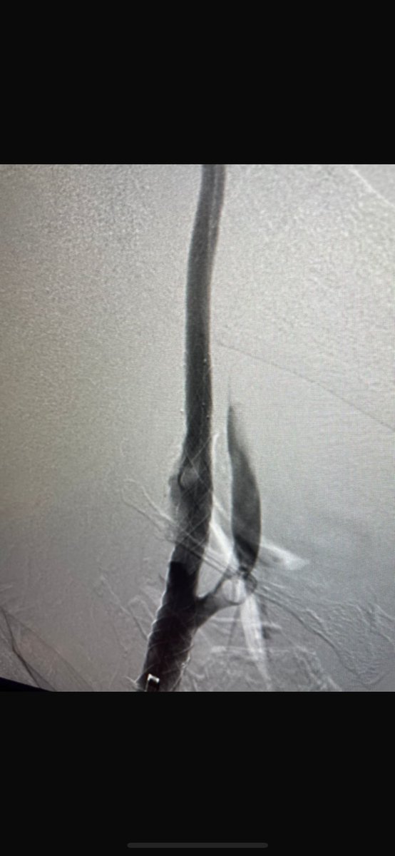 Abdulrahman Hamad Al-Abdulwahhab (@da7om206) on Twitter photo High-grade, concentric calcified internal carotid artery stenosis successfully managed with carotid artery  baloon angioplasty wiyh stenting through transradial approach.
Despite complex plaque morphology, optimal luminal restoration achieved.#Neurointervention #StrokePrevention High-grade, concentric calcified internal carotid artery stenosis successfully managed with carotid artery  baloon angioplasty wiyh stenting through transradial approach.
Despite complex plaque morphology, optimal luminal restoration achieved.#Neurointervention #StrokePrevention