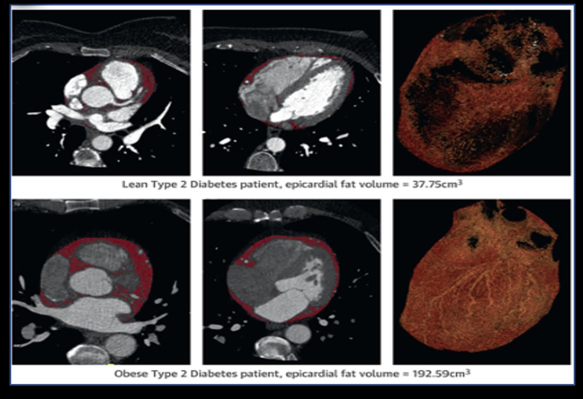 Circulation Research (@circres) on Twitter photo <a href="/CircRes/">Circulation Research</a> Compendium on Interorgan Crosstalk in #HeartFailure and #Cardiometabolic Diseases
#Multiorgan #Imaging for Interorgan Crosstalk in Cardiometabolic Diseases
ahajrnls.org/4mGYxgu
Authored by <a href="/anadevesa5/">Ana Devesa</a> & colleagues.
<a href="/BR_CMR/">Betty Raman</a> <a href="/Borjaibanez1/">Borja Ibanez</a> <a href="/VDelgadoGarcia/">Victoria Delgado</a> <a href="/CircRes/">Circulation Research</a> Compendium on Interorgan Crosstalk in #HeartFailure and #Cardiometabolic Diseases
#Multiorgan #Imaging for Interorgan Crosstalk in Cardiometabolic Diseases
ahajrnls.org/4mGYxgu
Authored by <a href="/anadevesa5/">Ana Devesa</a> & colleagues.
<a href="/BR_CMR/">Betty Raman</a> <a href="/Borjaibanez1/">Borja Ibanez</a> <a href="/VDelgadoGarcia/">Victoria Delgado</a>