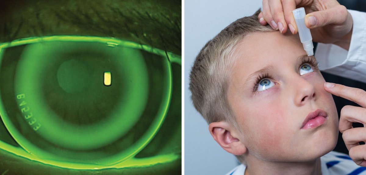 revoptom's tweet image. Atropine, Ortho-K Combo Enhances Myopia Control Outcomes

It comes at a cost, however. In a recent study, tear film stability and epithelial health were negatively impacted by the regimen.
reviewofoptometry.com/article/atropi…
#myopia #myopiacontrol #eyecare