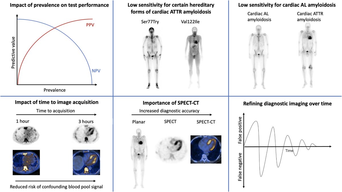 Yevgeniy Brailovsky DO MSc FACC (@yevgeniybr) on Twitter photo Is PYP ready for prime time for generalized screening for cardiac amyloidosis? An interesting debate of Pro Vs Con and overall perspective
journalofnuclearcardiology.org/article/S1071-…
<a href="/mallika_lalMD/">Mallika Lal</a>
<a href="/MasriAhmadMD/">Ahmad Masri</a>
<a href="/dr_a_ioannou/">Adam Ioannou</a>
<a href="/dr_m_fontana/">marianna fontana</a>
<a href="/MathewMaurer/">mathew.maurer</a>
<a href="/JNCjournal/">Journal of Nuclear Cardiology</a> Is PYP ready for prime time for generalized screening for cardiac amyloidosis? An interesting debate of Pro Vs Con and overall perspective
journalofnuclearcardiology.org/article/S1071-…
<a href="/mallika_lalMD/">Mallika Lal</a>
<a href="/MasriAhmadMD/">Ahmad Masri</a>
<a href="/dr_a_ioannou/">Adam Ioannou</a>
<a href="/dr_m_fontana/">marianna fontana</a>
<a href="/MathewMaurer/">mathew.maurer</a>
<a href="/JNCjournal/">Journal of Nuclear Cardiology</a>