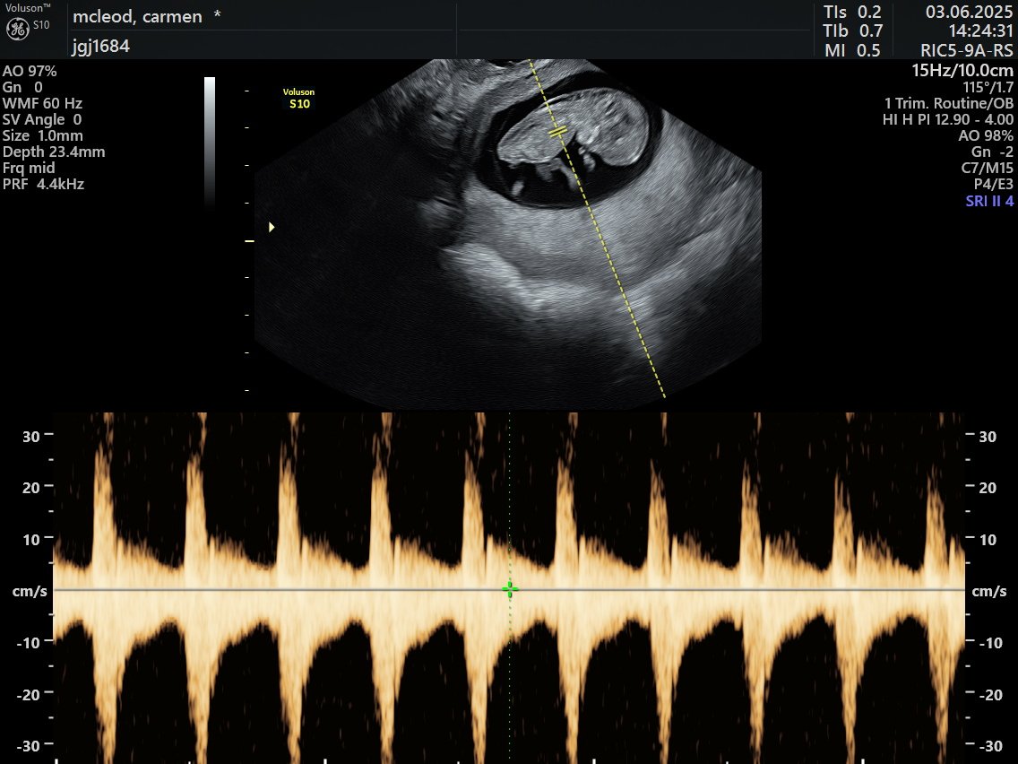 Little bean 🫘 due 23rd December ✨ got lucky and baby woke up during the sonar and wiggled around for us