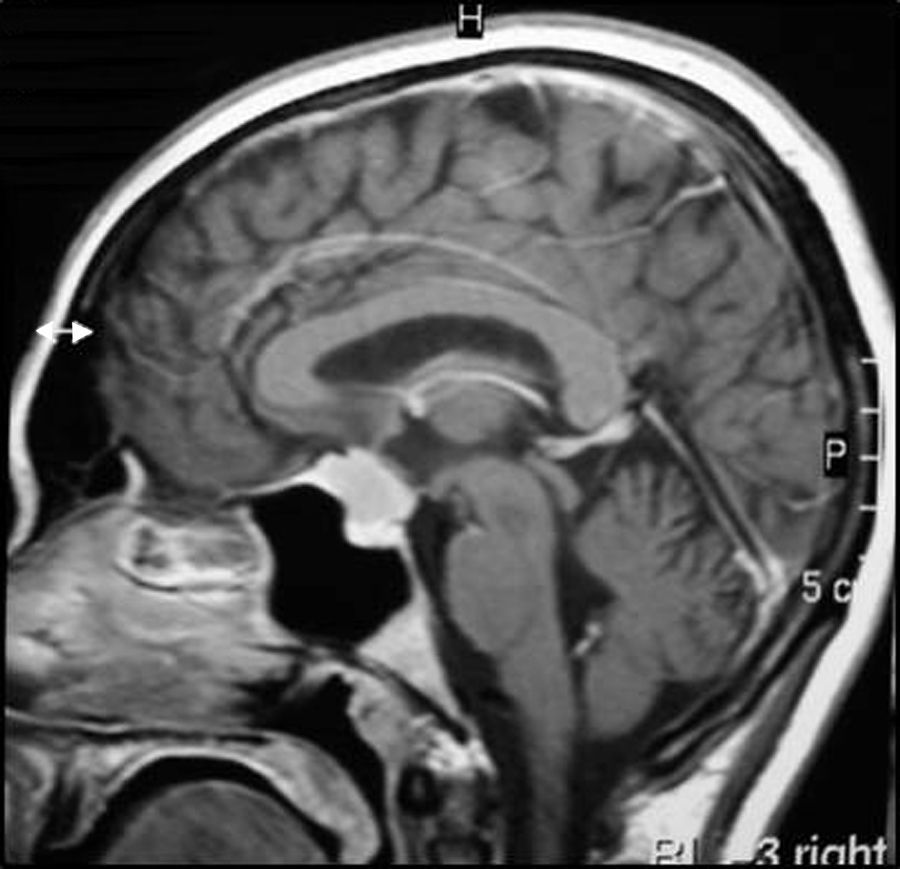⚡️Quick question: Sagittal T1 post-contrast.

⁉️Macroadenoma, meningioma… or something else?

💰What’s your diagnosis and why?