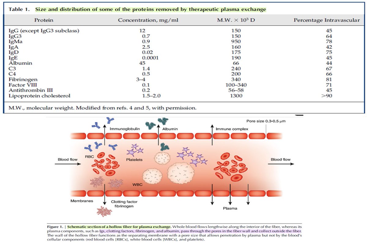 Recambio Plasmático Terapéutico (TPE) 🤓
#Nephrology #MedEd #NephX

(1/4)
✔️Técnica purificación sanguínea para remoción de moléculas grandes como anticuerpos/lipoproteinas
✔️Por centrifuga o por membrana 
✔️Centrifuga capacidad de aféresis celular, membrana NO
✔️Poros 0.3-5 mcm