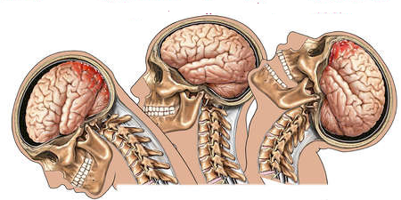 drdozellodc's tweet image. Concussions and Post-Concussion Syndrome
Dr Donald A Ozello DC, NSCA-CPT of Championship Chiropractic
Newsletter - June 2025
#concussion #concussions #postconcussionsyndrome #chiropractor #vegas #chiropractic #sportsmedicine icont.ac/513hn
