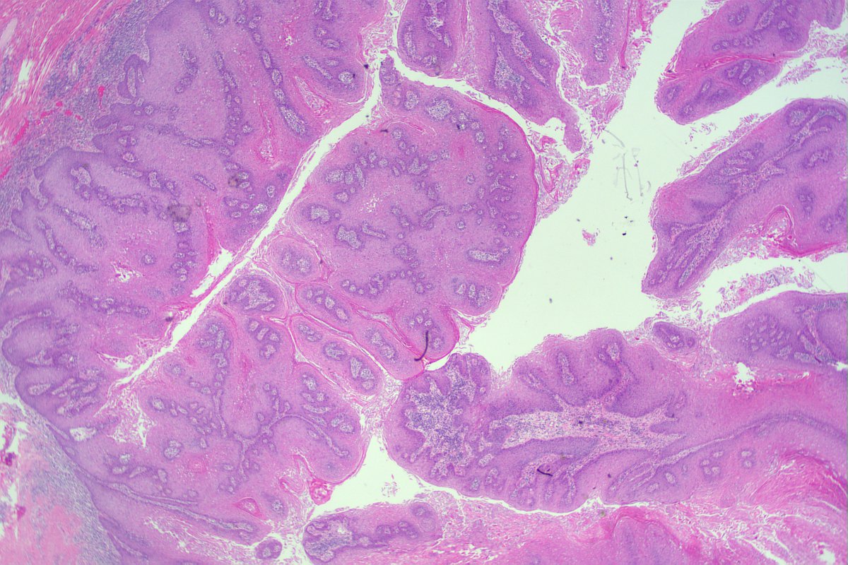 BeebsM1's tweet photo. 62M penile longstanding large penile lesion. Giant condyloma vs verrucous ca? I'm leaning toward giant condyloma (growth pattern, good koilo throughout) but others in dept disagree. Thoughts? Who is your go-to penile expert (my experience limited) #gupath https://t.co/dr8s5DCO0i