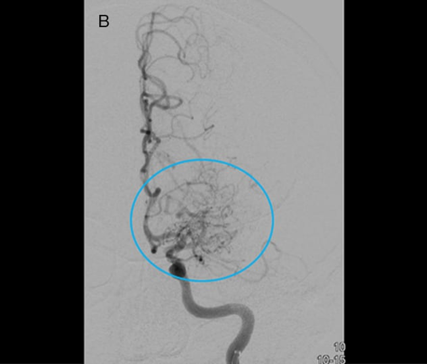 whitfieldlewis6's tweet photo. 25M of Japanese descent
PMH: Migraines + recurrent focal weakness
Presents with 20-min left-sided weakness
FHx: Early strokes in dad & uncle
📸 CTA + angiogram below
What’s the diagnosis? 👇
#NeuroTwitter #Stroke #TIA #NeuroCase https://t.co/c2oYdlXhPj