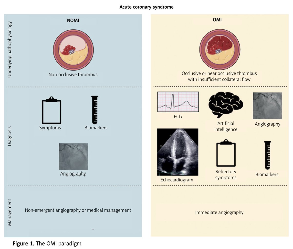 Willy Frick (@willyhfrick) on Twitter photo Occlusion myocardial infarction: a revolution in acute coronary syndrome
Read our editorial at the link below!
tinyurl.com/f33y6z3d
<a href="/ECGcases/">Jesse McLaren</a> <a href="/PendellM/">Pendell Meyers</a> <a href="/smithECGBlog/">Stephen W. Smith</a> Occlusion myocardial infarction: a revolution in acute coronary syndrome
Read our editorial at the link below!
tinyurl.com/f33y6z3d
<a href="/ECGcases/">Jesse McLaren</a> <a href="/PendellM/">Pendell Meyers</a> <a href="/smithECGBlog/">Stephen W. Smith</a>