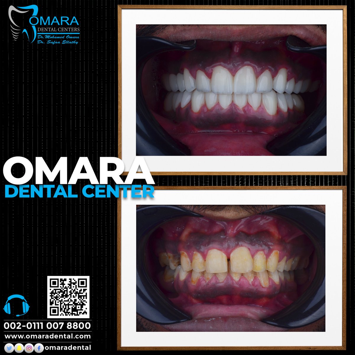 حالات تم علاجها 
مراكز الدكتور محمد عماره لطب الأسنان
حاصل على شهادة الجودة العالمية ISO
Omara Dental Center 
للحجز والاستفسارات
 ☎️ 00201110078800
 العنوان فرع التجمع الاول 🏨
📌 مول طبي نيوم ميديكال هاب (عياده رقم 9 &amp; 10) بجوار بوابه ١ منتجع النخيل امام أكادمية الشرطه
العنوان