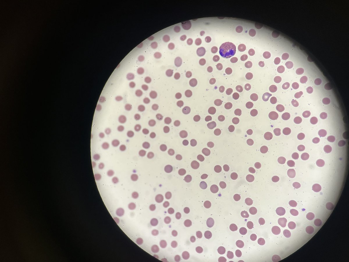 Hereditary spherocytosis #WCM Hematology