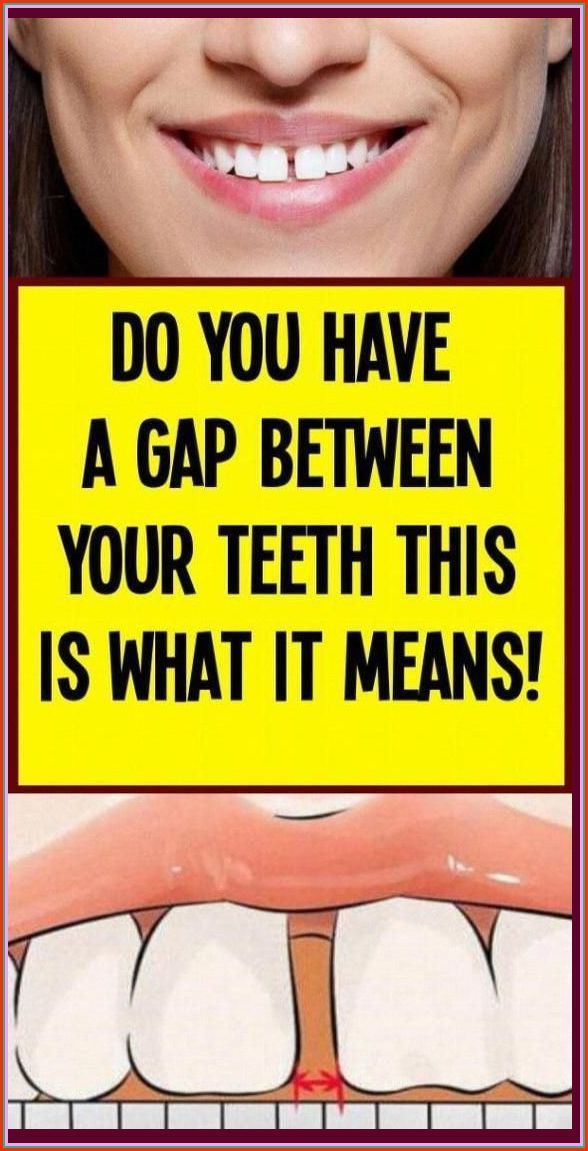Healthy_Mgz's tweet image. What Your Teeth Gap Reveals About You—Surprising Facts &amp;amp; Meanings🦷✨ 

healthmgz.com/2022/04/if-you…

#TeethGap #SmileSecrets #PersonalityTraits #DentalFacts #UniqueSmile #FunFacts #GapTooth #SelfDiscovery #SmileMore #TeethTalk #ConfidenceBoost