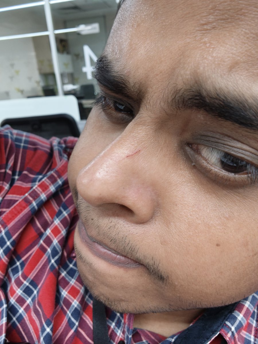 Idk how I got a cut on my nose 🤧