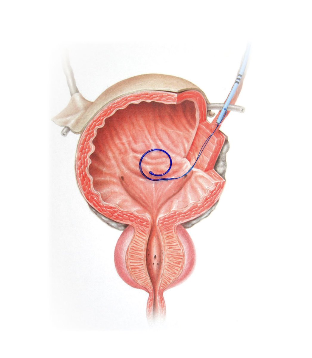 Jose Antonio Salvadó (@drsalvadostone) on Twitter photo Today we used the Relief Stent for the first time — a promising alternative for managing discomfort caused by double-J stents. Designed by urologists, this device aims to significantly improve patient tolerance to stent-related symptoms. <a href="/FelipePauchard/">Felipe Pauchard</a> <a href="/LPonsky/">Lee Ponsky</a> <a href="/CaseUrology/">University Hospitals Urology Institute</a> Today we used the Relief Stent for the first time — a promising alternative for managing discomfort caused by double-J stents. Designed by urologists, this device aims to significantly improve patient tolerance to stent-related symptoms. <a href="/FelipePauchard/">Felipe Pauchard</a> <a href="/LPonsky/">Lee Ponsky</a> <a href="/CaseUrology/">University Hospitals Urology Institute</a>