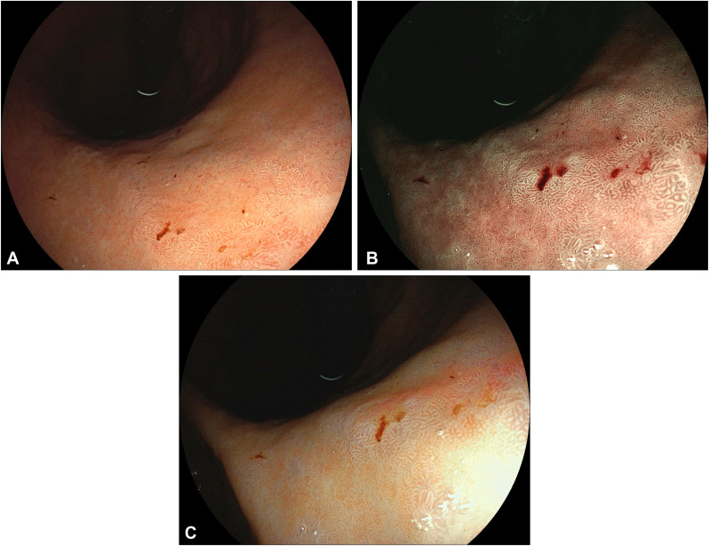 GIE (@gie_journal) on Twitter photo Shah identifies "Top tips for diagnosis and surveillance of gastric intestinal metaplasia." giejournal.org/article/S0016-…
#GITwitter
<a href="/ShailjaShahMD/">Shailja Shah, MD MPH</a> Shah identifies "Top tips for diagnosis and surveillance of gastric intestinal metaplasia." giejournal.org/article/S0016-…
#GITwitter
<a href="/ShailjaShahMD/">Shailja Shah, MD MPH</a>