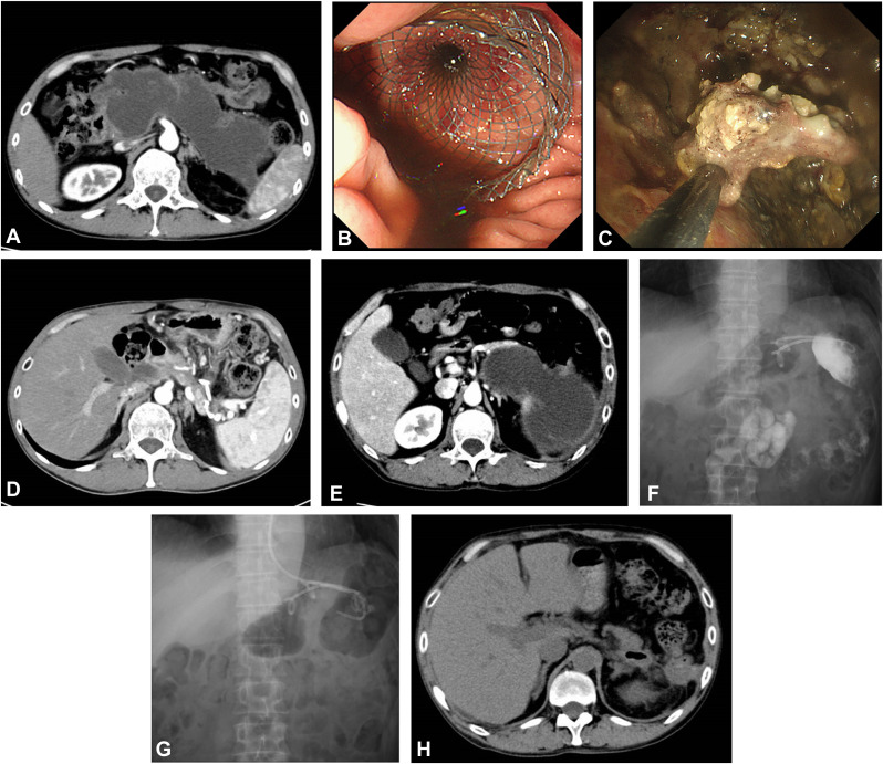 GIE (@gie_journal) on Twitter photo Tsujimae et al address "Necrosectomy and its timing in relation to clinical outcomes of EUS-guided treatment of walled-off pancreatic necrosis: a multicenter study." giejournal.org/article/S0016-…
#GITwitter
<a href="/YousukeNak54193/">Yousuke Nakai 中井 陽介</a> Tsujimae et al address "Necrosectomy and its timing in relation to clinical outcomes of EUS-guided treatment of walled-off pancreatic necrosis: a multicenter study." giejournal.org/article/S0016-…
#GITwitter
<a href="/YousukeNak54193/">Yousuke Nakai 中井 陽介</a>