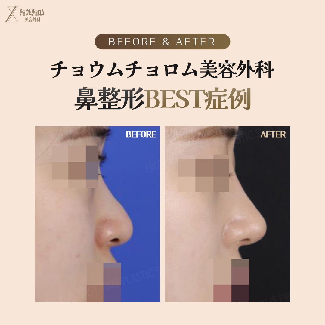 チョウムチョロムが教える
#整形手術 Before&amp;After

目、鼻手術はすべて自信あります。
チョウムチョロム美容外科では’工場式’のような画一的な手術は行いません。
患者の目、鼻の形と年齢、シーズンなどの状態に合わせて
1：1パーソナライズで安全に手術を行う事をお約束します。