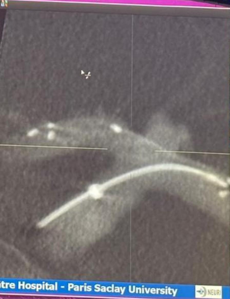 Evasc wishes to thank Laurent Spelle for a masterful job delivering the eCLIPs bifurcation flow diverter, eBFD, into a perfect position; and congratulate Jacques Moret and Vitor Pereira on narrating the nuances of eCLIPs use. And to all 3 for a most instructive LINNC meeting.