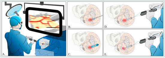 JCM MDPI (@jcm_mdpi) on Twitter photo #mdpijcm
📢Call for Reading
Minimally Invasive Surgery for #Spontaneous_Intracerebral_Hemorrhage: A Review
✨mdpi.com/3176608
by Nourou Dine Adeniran Bankole et al.
<a href="/Nourou03/">Bankole Nourou Dine A.MD, MSc, PhD student</a>
<a href="/MediPharma_MDPI/">MDPI Medicine & Pharmacology</a> #mdpijcm
📢Call for Reading
Minimally Invasive Surgery for #Spontaneous_Intracerebral_Hemorrhage: A Review
✨mdpi.com/3176608
by Nourou Dine Adeniran Bankole et al.
<a href="/Nourou03/">Bankole Nourou Dine A.MD, MSc, PhD student</a>
<a href="/MediPharma_MDPI/">MDPI Medicine & Pharmacology</a>
