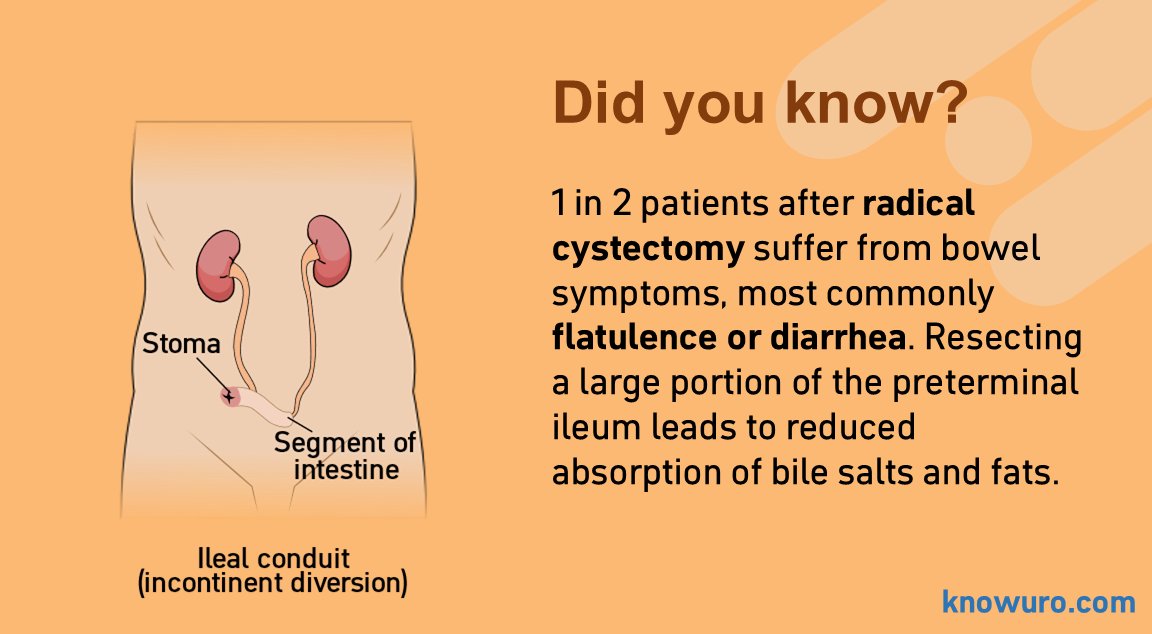 #Urologists often overlook bowel symptoms after RC—especially in younger patients and those with neobladders.

These symptoms can seriously impact quality of life. Don’t forget to ask. 
Don’t forget to manage.
