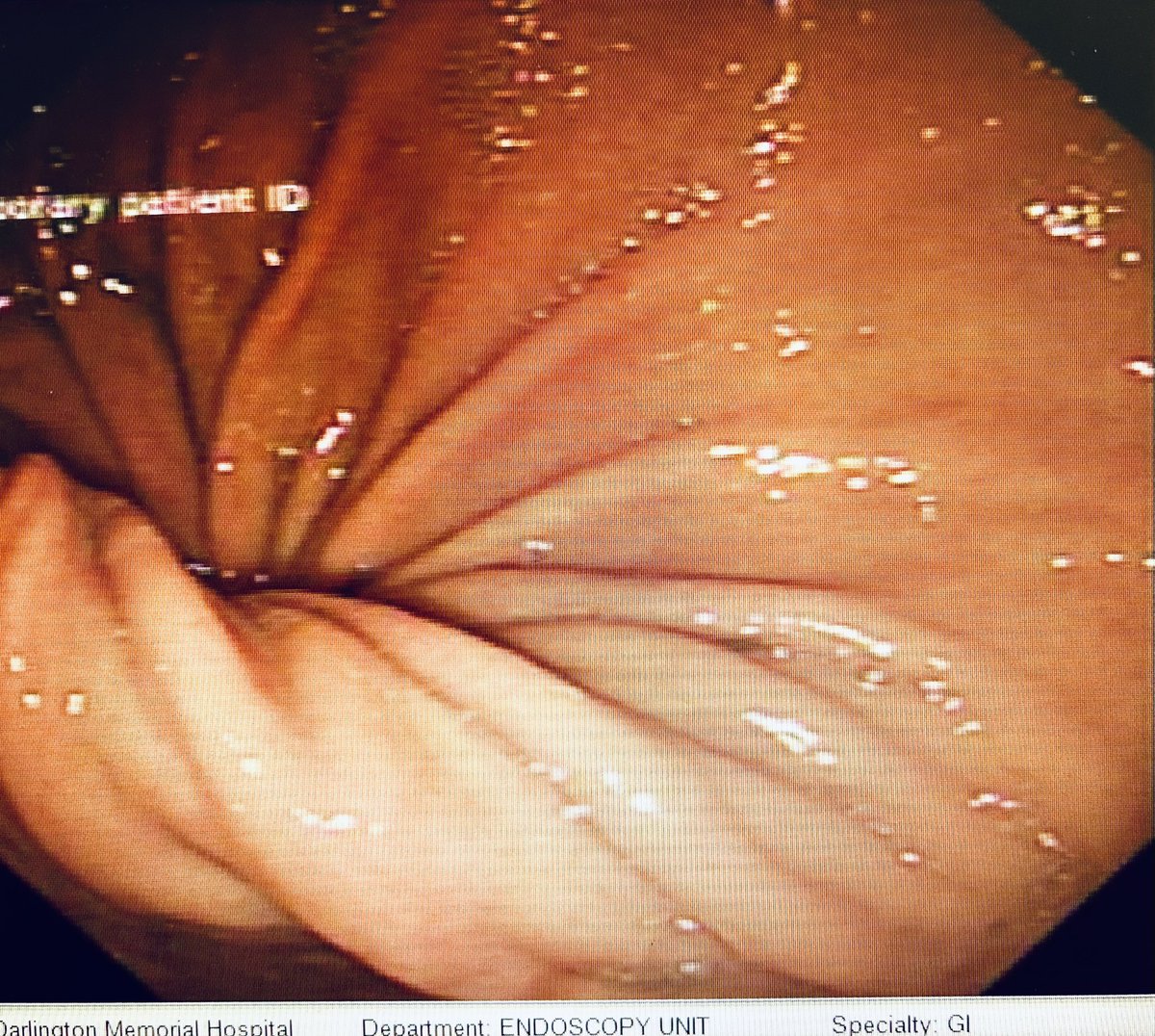 Anjan Dhar (@anjan_dhar6) on Twitter photo An interesting appearance of the stomach on an elderly patient with vomiting and haematemesis. What would you do here and why? Any further investigations? <a href="/BSGTrainees/">BSG Trainees</a> An interesting appearance of the stomach on an elderly patient with vomiting and haematemesis. What would you do here and why? Any further investigations? <a href="/BSGTrainees/">BSG Trainees</a>