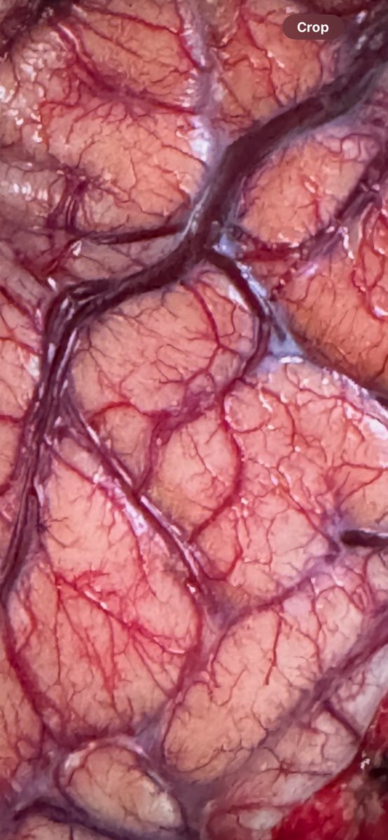 Surface of brain 🧠 at 10X
See intricate arteries veins capillaries