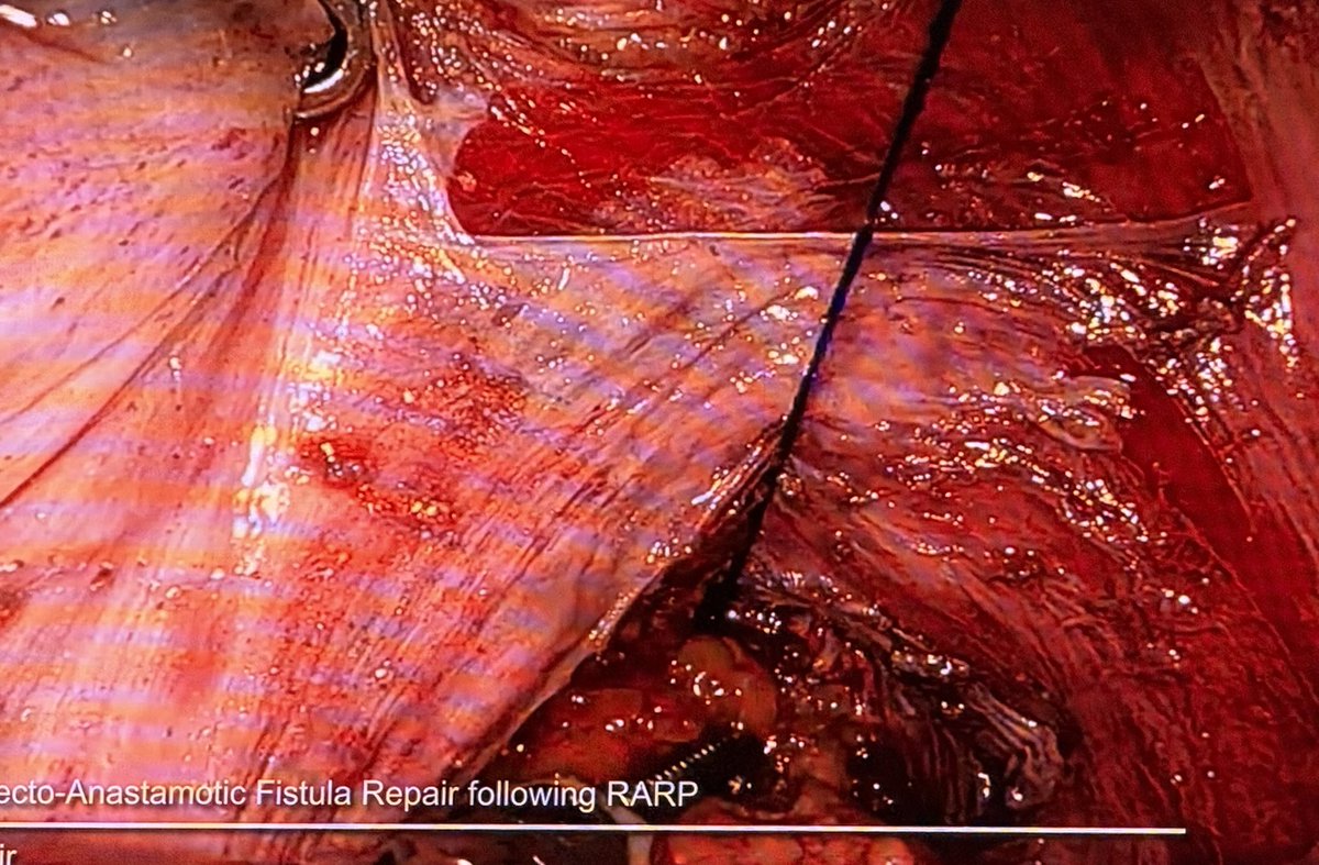 Prof. Prokar Dasgupta OBE (@prokarurol) on Twitter photo <a href="/nairajesh/">Rajesh Nair</a> from <a href="/GuysUrology/">Guy's Urology News</a> presents a difficult case of rectourethral fistula repair at #CILR26
✅Rectum repaired in two layers
✅Bladder neck repair through the bladder with stents in place
✅Omental interposition
✅Defunctioning colostomy <a href="/nairajesh/">Rajesh Nair</a> from <a href="/GuysUrology/">Guy's Urology News</a> presents a difficult case of rectourethral fistula repair at #CILR26
✅Rectum repaired in two layers
✅Bladder neck repair through the bladder with stents in place
✅Omental interposition
✅Defunctioning colostomy