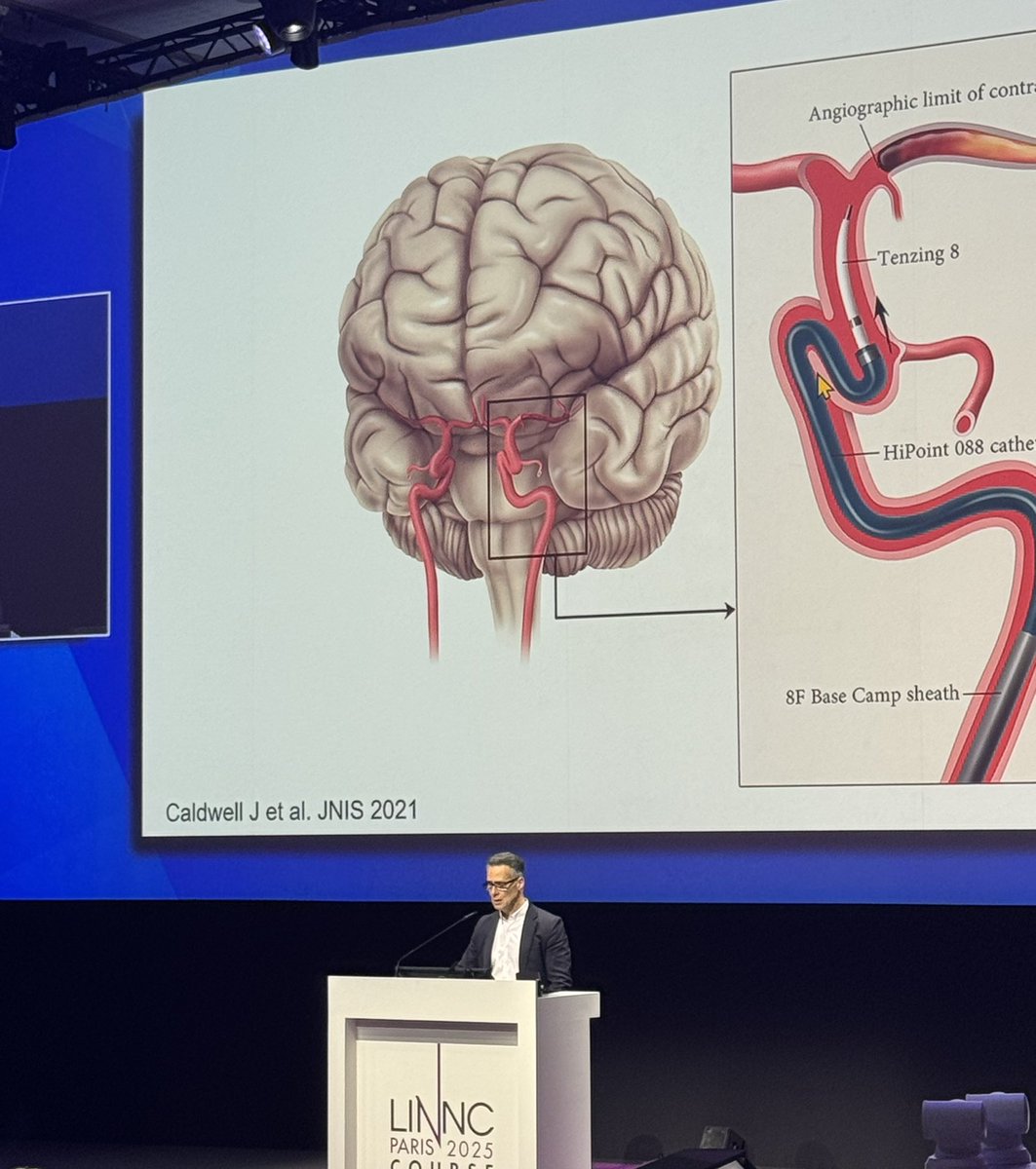 UPittStroke (@pittstroke) on Twitter photo Presenting the results of SUMMIT MAX, discussing distal thrombectomy, and Thrombectomy without Borders, <a href="/RaulNogueiraMD/">Raul G Nogueira, MD, FAHA, FSVIN</a> at LINNC Paris <a href="/PittNeurology/">Pitt Neurology</a> Presenting the results of SUMMIT MAX, discussing distal thrombectomy, and Thrombectomy without Borders, <a href="/RaulNogueiraMD/">Raul G Nogueira, MD, FAHA, FSVIN</a> at LINNC Paris <a href="/PittNeurology/">Pitt Neurology</a>