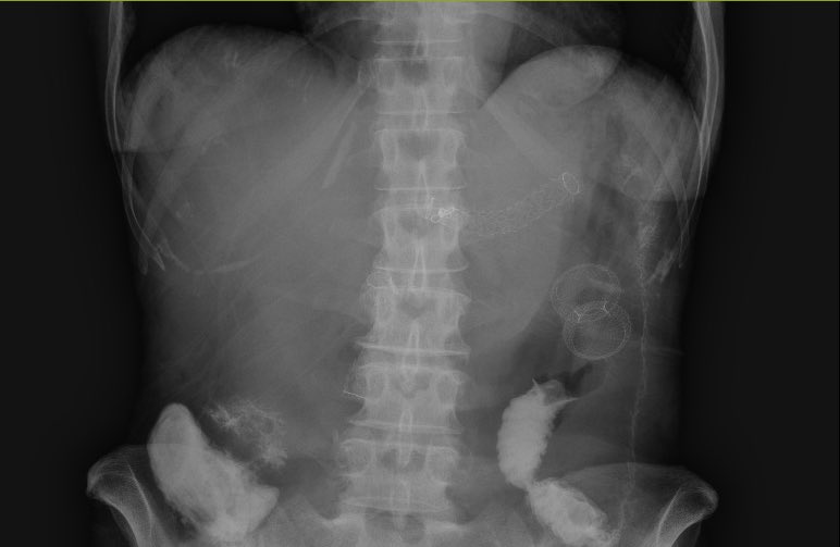 Vishnu Kumar (@dr_vishnukumar) on Twitter photo 😃 faces after a successful EUS-GJ + HGS for malignant GOO and obstruction of the previously placed CBD SEMS to help our patient with the incredibly talented <a href="/Jean_Chalhoub/">Jean Chalhoub</a>
Grateful to learn from this ⭐️ team lead by <a href="/shandrawes/">Sherif Andrawes MD</a> <a href="/NorthwellHealth/">Northwell Health</a> <a href="/ASGEendoscopy/">ASGE GI Endoscopy</a> <a href="/NYSGE/">NYSGE</a> 😃 faces after a successful EUS-GJ + HGS for malignant GOO and obstruction of the previously placed CBD SEMS to help our patient with the incredibly talented <a href="/Jean_Chalhoub/">Jean Chalhoub</a>
Grateful to learn from this ⭐️ team lead by <a href="/shandrawes/">Sherif Andrawes MD</a> <a href="/NorthwellHealth/">Northwell Health</a> <a href="/ASGEendoscopy/">ASGE GI Endoscopy</a> <a href="/NYSGE/">NYSGE</a>