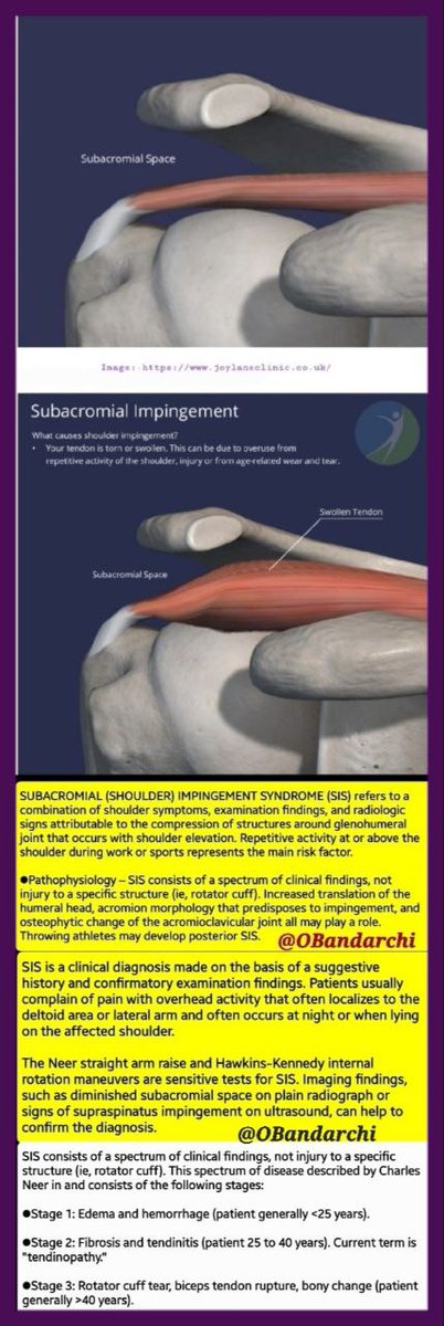 🛑Subacromial(shoulder) impingement syndrome(SIS) refers to a combination of shoulder symptoms,PE findings &amp; radiologic signs attributable to compression of structures around the GHJ that occurs with shoulder elevation.Repetitive activity at/above shoulder is the main risk factor