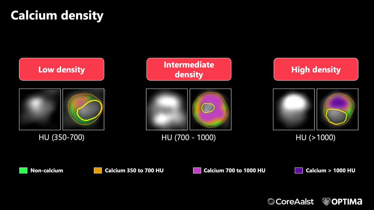 Carlos Collet MD PhD (@colletcarlos) on Twitter photo 💠Ever wondered if coronary calcium is soft or rock-hard—before you ballon it?
🚨 With CT calcium density, you can now predict calcium behavior.
👨‍🏫 Come and learn with us on July 7–8 onsite or streaming registration.ctcourse-orsi2025.com/ctorsi25
<a href="/PCRonline/">PCRonline 🫀</a> <a href="/OptimaCTO/">Optima Education</a> <a href="/TCTMD/">TCTMD</a> <a href="/CoreAalst/">CoreAalst</a> 💠Ever wondered if coronary calcium is soft or rock-hard—before you ballon it?
🚨 With CT calcium density, you can now predict calcium behavior.
👨‍🏫 Come and learn with us on July 7–8 onsite or streaming registration.ctcourse-orsi2025.com/ctorsi25
<a href="/PCRonline/">PCRonline đź«€</a> <a href="/OptimaCTO/">Optima Education</a> <a href="/TCTMD/">TCTMD</a> <a href="/CoreAalst/">CoreAalst</a>