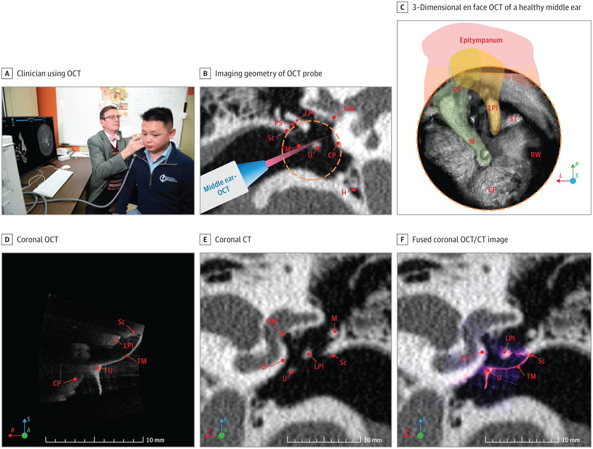 Middle ear optical coherence tomography (OCT), computed tomography (CT), and fused OCT/CT imaging can each provide useful, complementary diagnostic information in clinical otology. ja.ma/3FylYrO