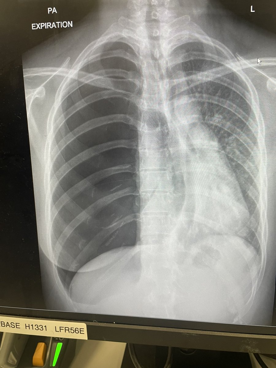 seekingwatson's tweet photo. A week ago I had one lung, now I’ve got two and I’m on my way home. In all, a good week. https://t.co/rCwCQF3CjK