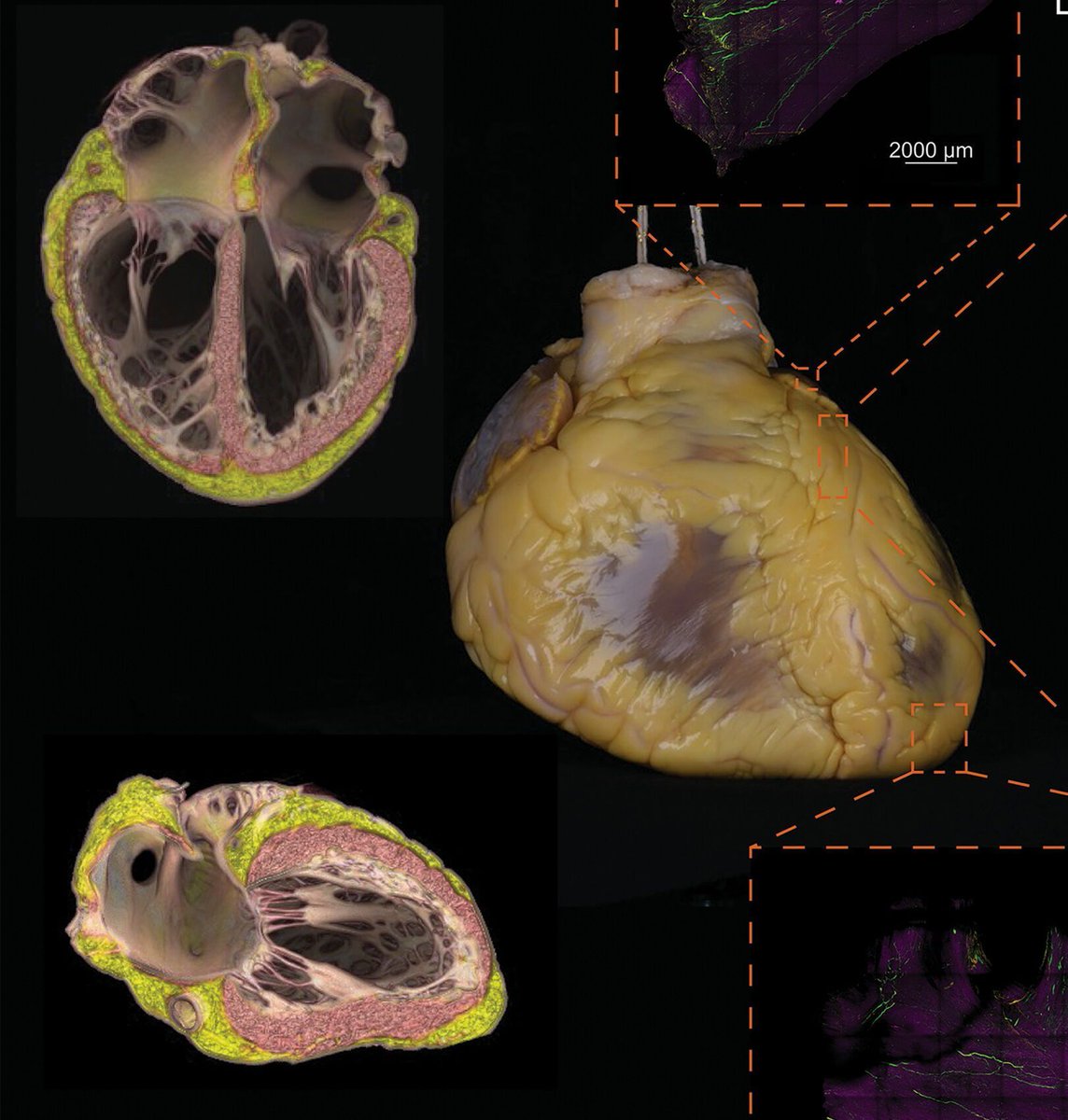 New research reveals detailed 3D maps of heart nerve networks: cholinergic nerves dominate the sinoatrial node, while noradrenergic input is stronger in the ventricles. In cardiomyopathy, nerve remodeling disrupts this balance.
Peter Hanna et al.: anatomypubs.onlinelibrary.wiley.com/doi/10.1002/ar…