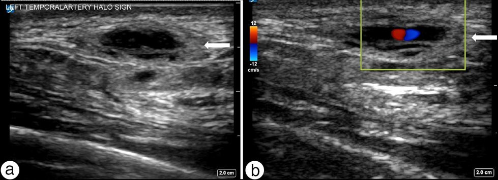POCUS Journal club take-home point #1: POCUS can be used to rapidly diagnose temporal arteritis in patients with temporal headache, expediting appropriate treatment.

pubmed.ncbi.nlm.nih.gov/35991713/