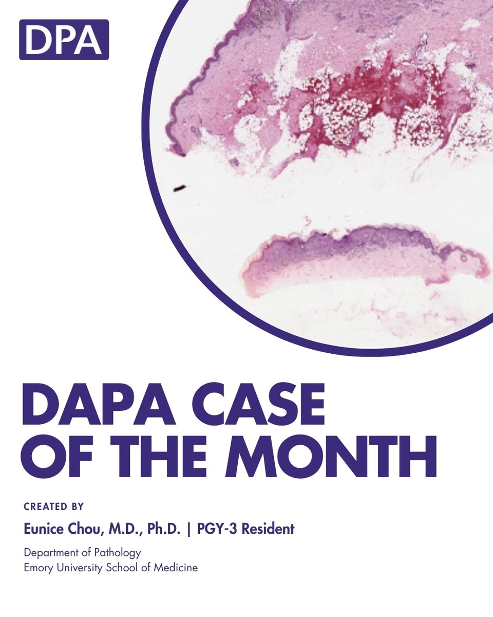 dpatweet's tweet image. An 8-year-old boy presents to the clinic with an 8 mm pink dome-shaped papule on the left thigh. Microscopic examination of the biopsied lesion shows nests of cells that are positive for S100, SOX10, and Melan-A expression on immunohistochemistry.
zurl.co/Z9zpS