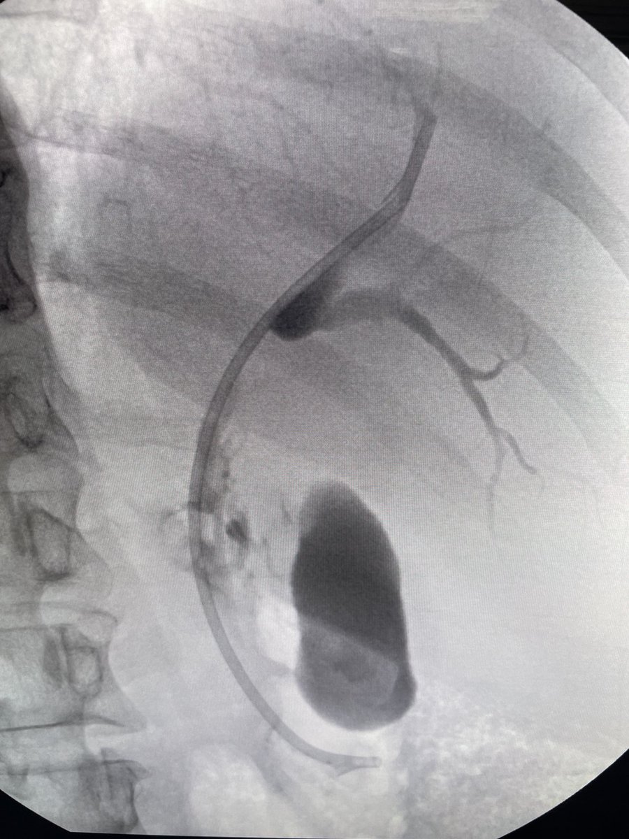 Douglas G. Adler MD, FASGE, FACG, AGAF (@douglasadlermd) on Twitter photo Cholangiocarcinoma. Entire left lobe replaced by mass. Tight hilar stricture. Right side stented to good effect. #gitwitter #surgery <a href="/NEndoscopy/">Prof John Leeds</a> <a href="/NealMehtaMD/">Neal Mehta</a> <a href="/EUSandEndoscopy/">Scot Michael Lewey</a> <a href="/RahulKarnaMD/">Rahul Karna, MD</a> Cholangiocarcinoma. Entire left lobe replaced by mass. Tight hilar stricture. Right side stented to good effect. #gitwitter #surgery <a href="/NEndoscopy/">Prof John Leeds</a> <a href="/NealMehtaMD/">Neal Mehta</a> <a href="/EUSandEndoscopy/">Scot Michael Lewey</a> <a href="/RahulKarnaMD/">Rahul Karna, MD</a>