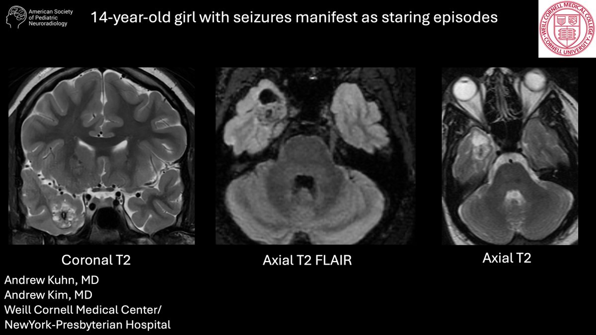Case of the week: 14-year-old girl with seizures manifest as staring episodes bit.ly/4jxTM6h Andrew Kuhn, MD, and Andrew Kim, MD, Weill Cornell Medical Center/ NewYork-Presbyterian Hospital #PediNeuroRad #MedEd #FOAMrad #PedsRad