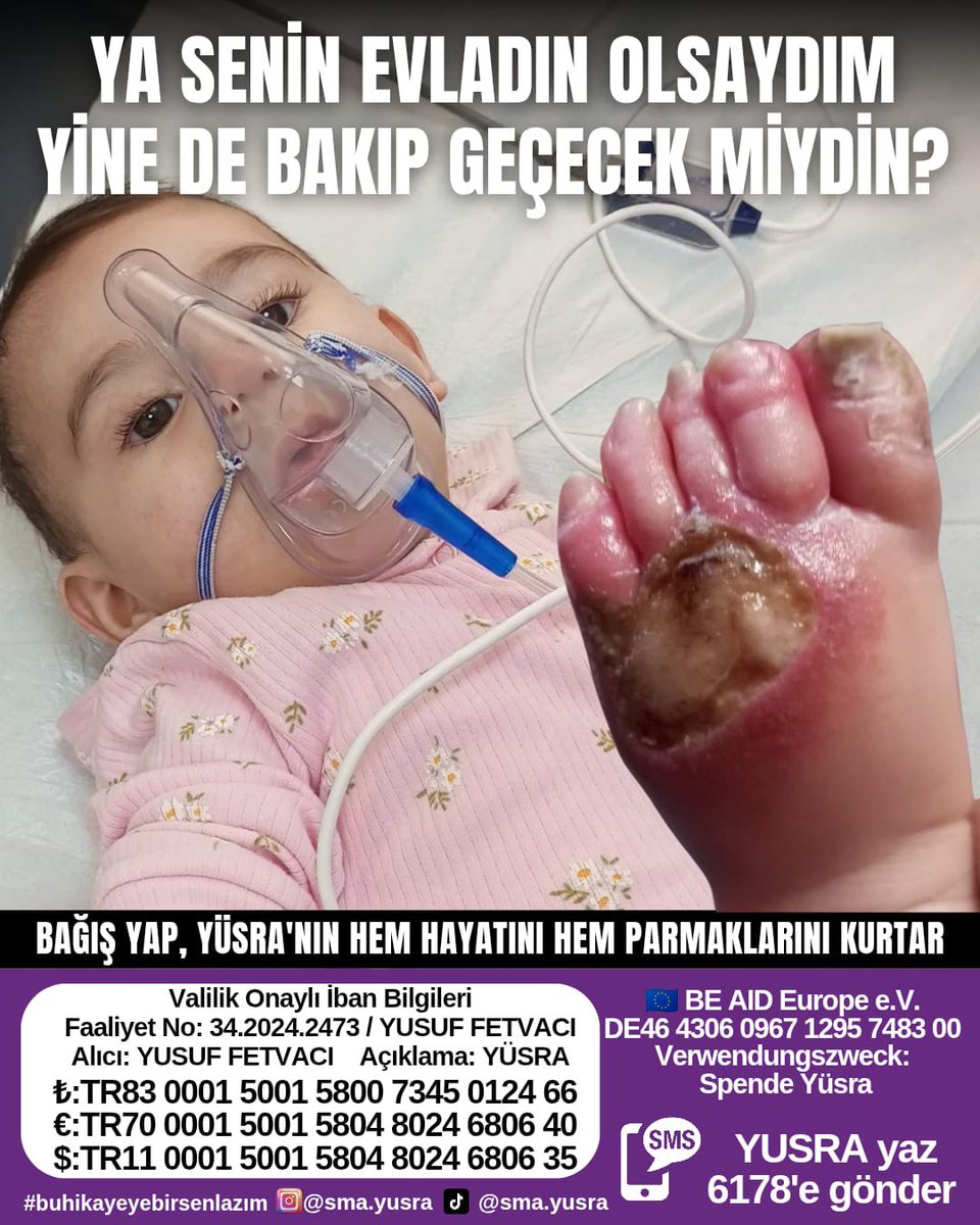 DİLEK 🇹🇷 🐺🐾𐰓𐰃𐰠𐰀𐰚 (@kutseli_77) on Twitter photo <a href="/smayusrafetvaci/">Yüsra Fetvacı SMA tip 1</a> yı
gören herkes küçük bir bağış yapıp çevresinde paylaşırsa evladımızı ilacına kavuşturacağız. Birlikte başarabiliriz. 🙏
Hem sma hem de kangrenle mücadele ediyor ve her gün yaraları artıyor 😔
YUSRA yaz 6178 gönder
TR83 0001 5001 5800 7345 0124 66
Yusuf <a href="/smayusrafetvaci/">Yüsra Fetvacı SMA tip 1</a> yı
gören herkes küçük bir bağış yapıp çevresinde paylaşırsa evladımızı ilacına kavuşturacağız. Birlikte başarabiliriz. 🙏
Hem sma hem de kangrenle mücadele ediyor ve her gün yaraları artıyor 😔
YUSRA yaz 6178 gönder
TR83 0001 5001 5800 7345 0124 66
Yusuf