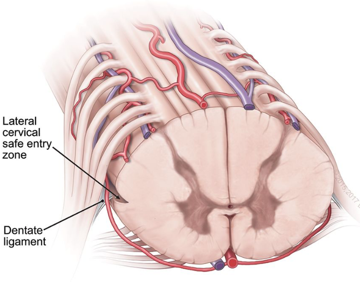 Michael T. Lawton, MD (@mtlawton) on Twitter photo Watch this Seven Series video showing this C6 laminectomy, resection of cervical spinal cord cavernous malformation between the dorsal and ventral nerve roots, and alongside corticospinal tract, on our website <a href="/BarrowNeuro/">BarrowNeurological</a> by clicking on this link…Bar.rw/7series. Watch this Seven Series video showing this C6 laminectomy, resection of cervical spinal cord cavernous malformation between the dorsal and ventral nerve roots, and alongside corticospinal tract, on our website <a href="/BarrowNeuro/">BarrowNeurological</a> by clicking on this link…Bar.rw/7series.