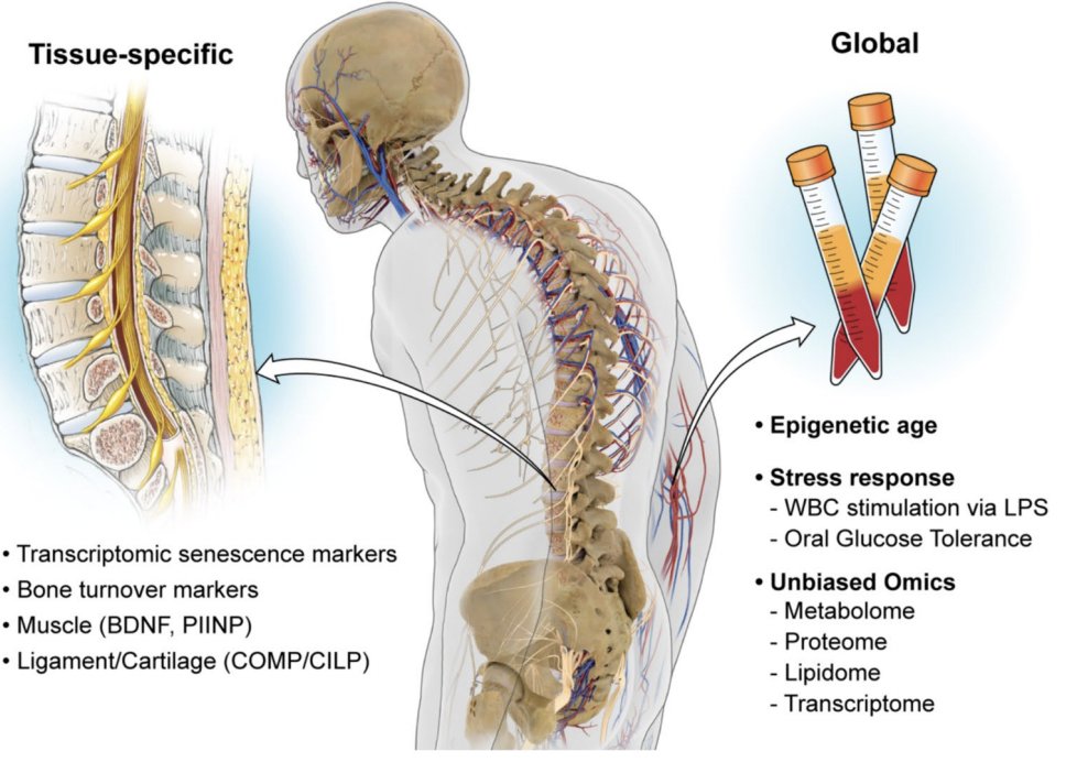 Tej D. Azad 🇺🇸 (@tdazad) on Twitter photo Biomarkers, Aging, & Adult Spinal Deformity, work on behalf of the <a href="/SRS_org/">Scoliosis Research Society</a> Task Force on Senescence
link.springer.com/article/10.100…
Grateful to <a href="/camesmd/">Christopher Ames MD</a>, <a href="/JeremyWalstonMD/">Jeremy Walston MD</a>, Drs. Eastlack, Pellise, & the Task Force for their guidance <a href="/spinesection/">AANS/CNS Spine Section</a> <a href="/hopkins_HAP/">Johns Hopkins - Human Aging Project</a> <a href="/agingbiomarkers/">Biomarkers of Aging Consortium</a> Biomarkers, Aging, & Adult Spinal Deformity, work on behalf of the <a href="/SRS_org/">Scoliosis Research Society</a> Task Force on Senescence
link.springer.com/article/10.100…
Grateful to <a href="/camesmd/">Christopher Ames MD</a>, <a href="/JeremyWalstonMD/">Jeremy Walston MD</a>, Drs. Eastlack, Pellise, & the Task Force for their guidance <a href="/spinesection/">AANS/CNS Spine Section</a> <a href="/hopkins_HAP/">Johns Hopkins - Human Aging Project</a> <a href="/agingbiomarkers/">Biomarkers of Aging Consortium</a>