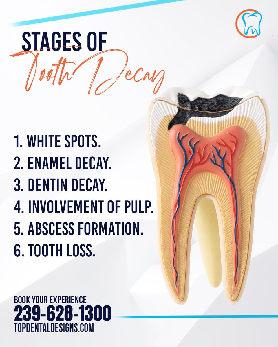 mydentaldesigns's tweet image. 🛑 5 Stages of Tooth Decay – Know the Signs Tooth decay doesn’t happen overnight. If you’re feeling any discomfort, don’t wait. We’re offering FREE consultations to help you take action early!
📞 Call us: 239-628-1300
#ToothDecay #OralHealth #DentalCare