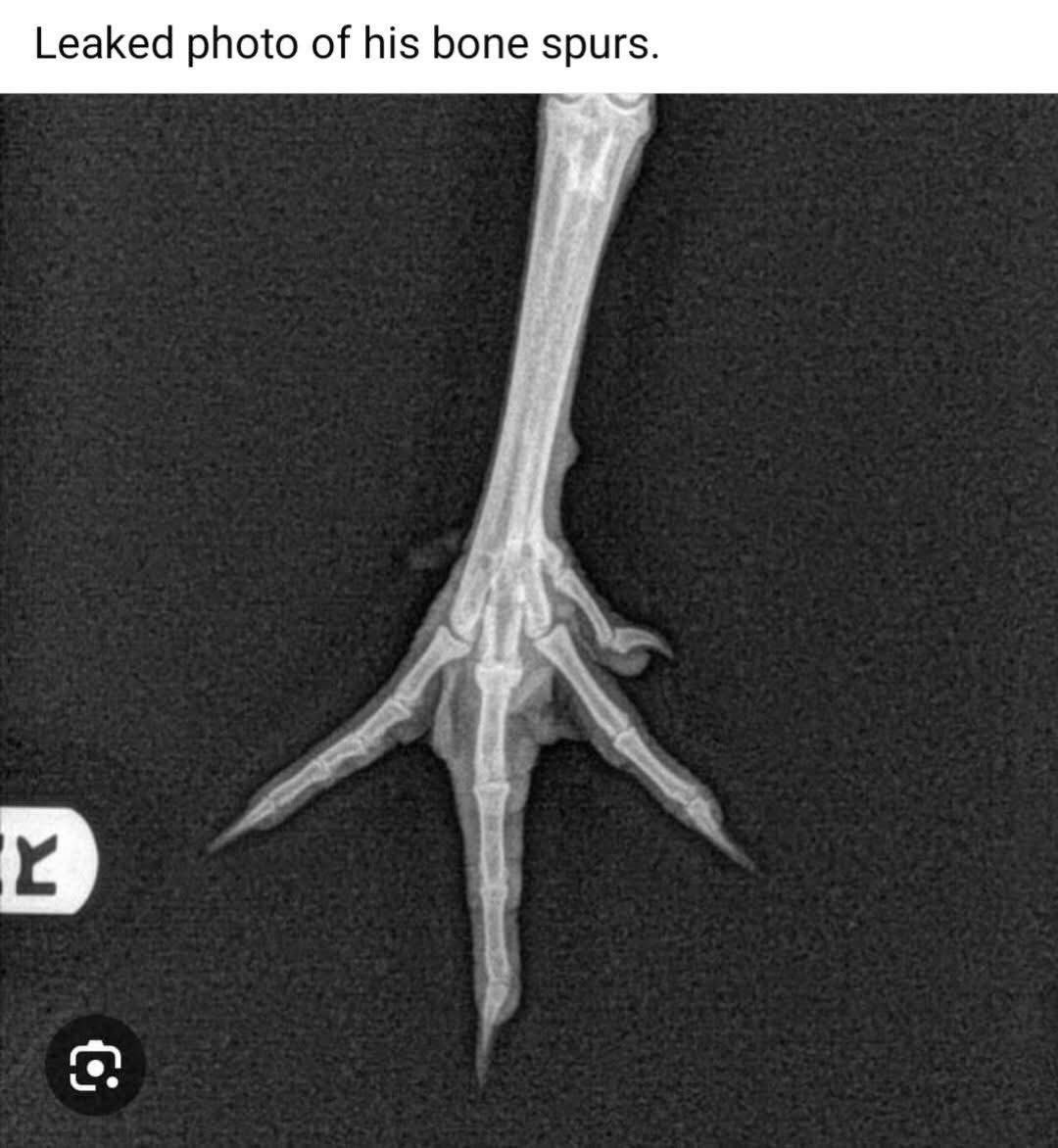 GaryDR27's tweet photo. @TheRickWilson Bone spurs https://t.co/FPnMkocWeJ