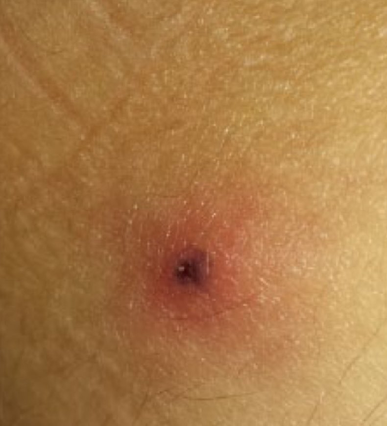 Gorączka + eschar (czarny strupek) + pobyt w Afryce południowej = afrykańska gorączka odkleszczowa. 
Coś w stylu „Strassen diagnose”, kiedy bez badań laboratoryjnych można rozpoznać chorobę. Ostatnio u mojej pacjentki w szpitalu po pobycie w RPA. Czas wylęgania 5-10 dni.