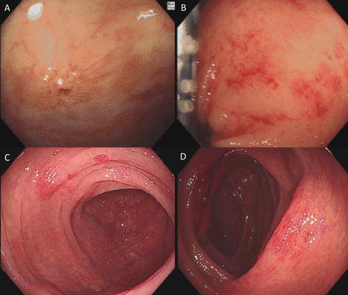 Frontline Gastro (@frontgastro_bmj) on Twitter photo π Check point inhibitor colitis π . It can be tricky to diagnose, treat and determine whether checkpoint inhibitors can be reintroduced!
π Thanks again to the authors <a href="/dr_aditi_kumar/">Aditi Kumar</a> <a href="/Phil_Harvey1/">Phil Harvey</a> for helping us navigate this conundrum π . Check out π π Check point inhibitor colitis π . It can be tricky to diagnose, treat and determine whether checkpoint inhibitors can be reintroduced!
π Thanks again to the authors <a href="/dr_aditi_kumar/">Aditi Kumar</a> <a href="/Phil_Harvey1/">Phil Harvey</a> for helping us navigate this conundrum π . Check out π