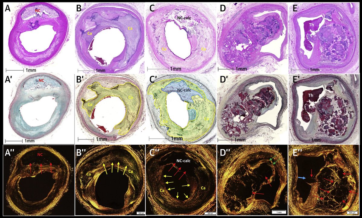 Did you see the jiggle? 

Thoughts about an eruptive calcified nodule. A 🧵

At <a href="/OPCILive/">OPCI</a> this past week, <a href="/ziadalinyc/">Ziad Ali</a> shared a case involving an eruptive CN.

In his inimitable (and purposefully provocative 😂) style, he asked the audience if we could see the haziness ‘jiggle’.
