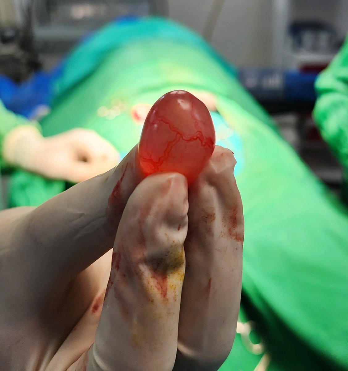 🎗️ epididymal cyst.
🎗️Small but symptomatic.
🎗️ meticulous dissection to avoid any complications.