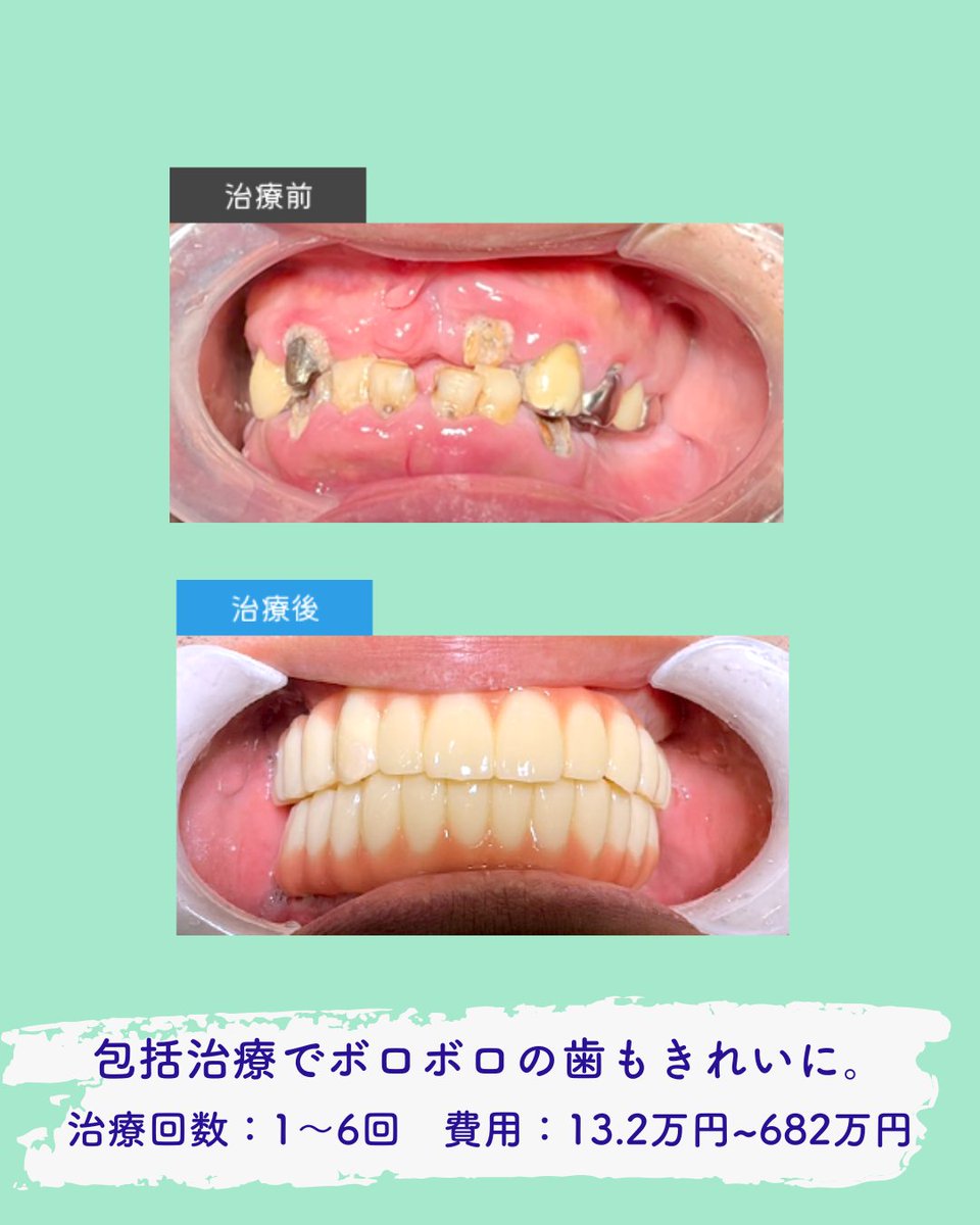 yorisoudc's tweet photo. ボロボロの歯でも治せます。

包括治療という虫歯、歯周病、噛み合わせなどの原因を総合的に診断し、治療を行う治療で歯がボロボロ、何も本も抜けてしまっていてもきれいに治すことができます。

まずは費用なども含めまずはご相談ください🦷

#北千住 #歯医者 #包括治療
#インプラント #歯医者嫌い https://t.co/D59a4YLJMA