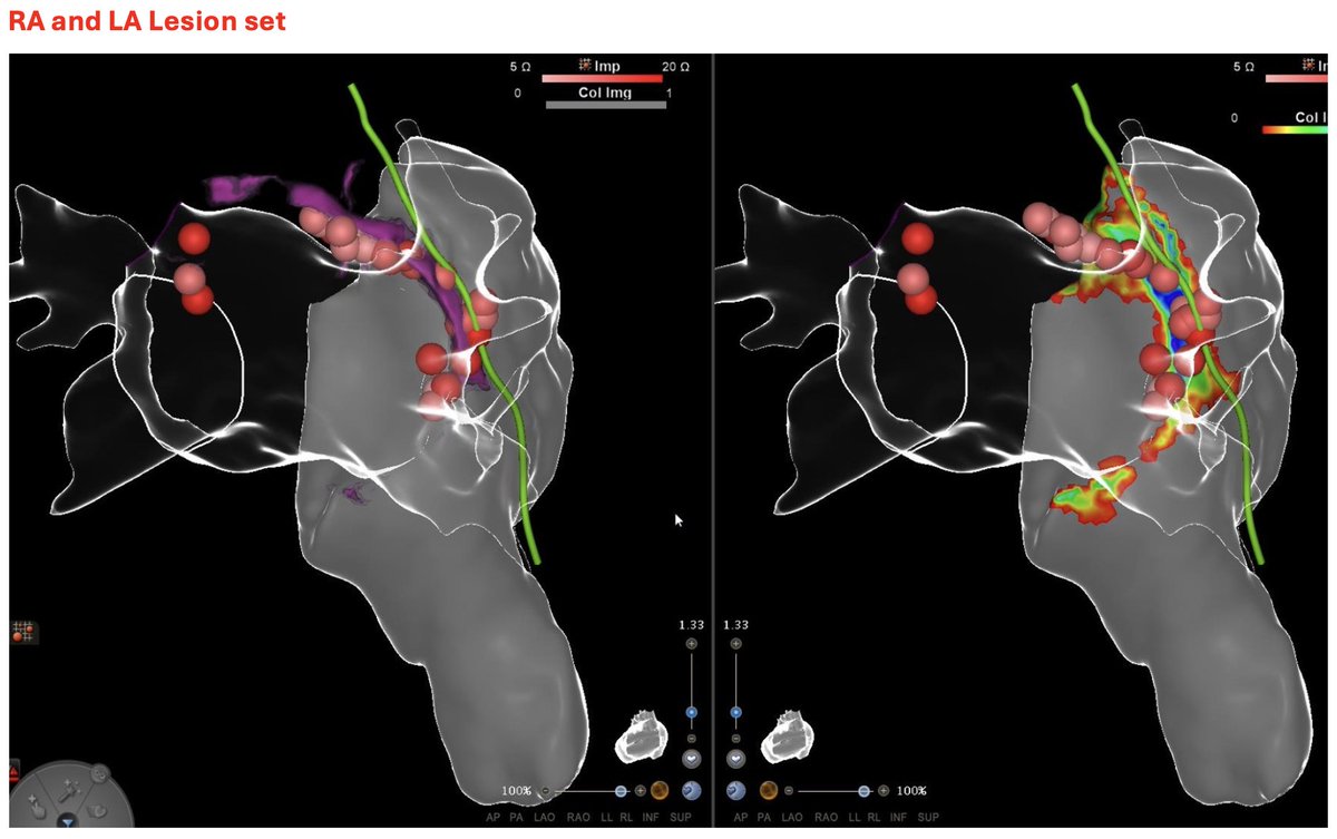 inHEART (@inheartmedical) on Twitter photo First #CNA case at <a href="/WellSpan/">WellSpan Health</a> Hospital using #inHEART!
3D imaging integration enabled precise targeting of the #GPs in both the left and right atria, resulting in a successful ablation procedure. The patient was admitted with a sinus rate of 45–55 bpm. Post-procedure, the rate First #CNA case at <a href="/WellSpan/">WellSpan Health</a> Hospital using #inHEART!
3D imaging integration enabled precise targeting of the #GPs in both the left and right atria, resulting in a successful ablation procedure. The patient was admitted with a sinus rate of 45–55 bpm. Post-procedure, the rate
